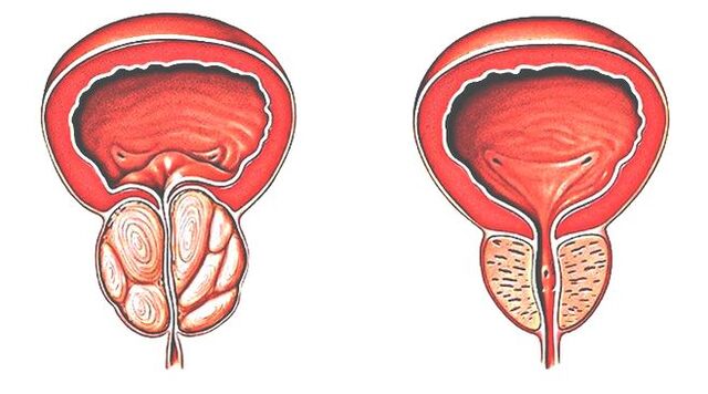 Prostatite e próstata normal