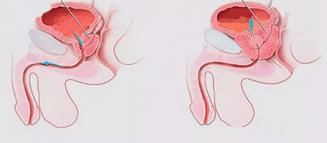 Sinais de prostatite em homens