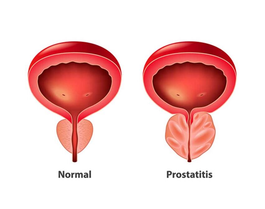 Próstata normal e inflamatória